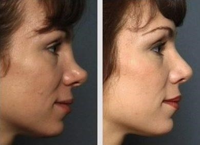 what is a closed rhinoplasty